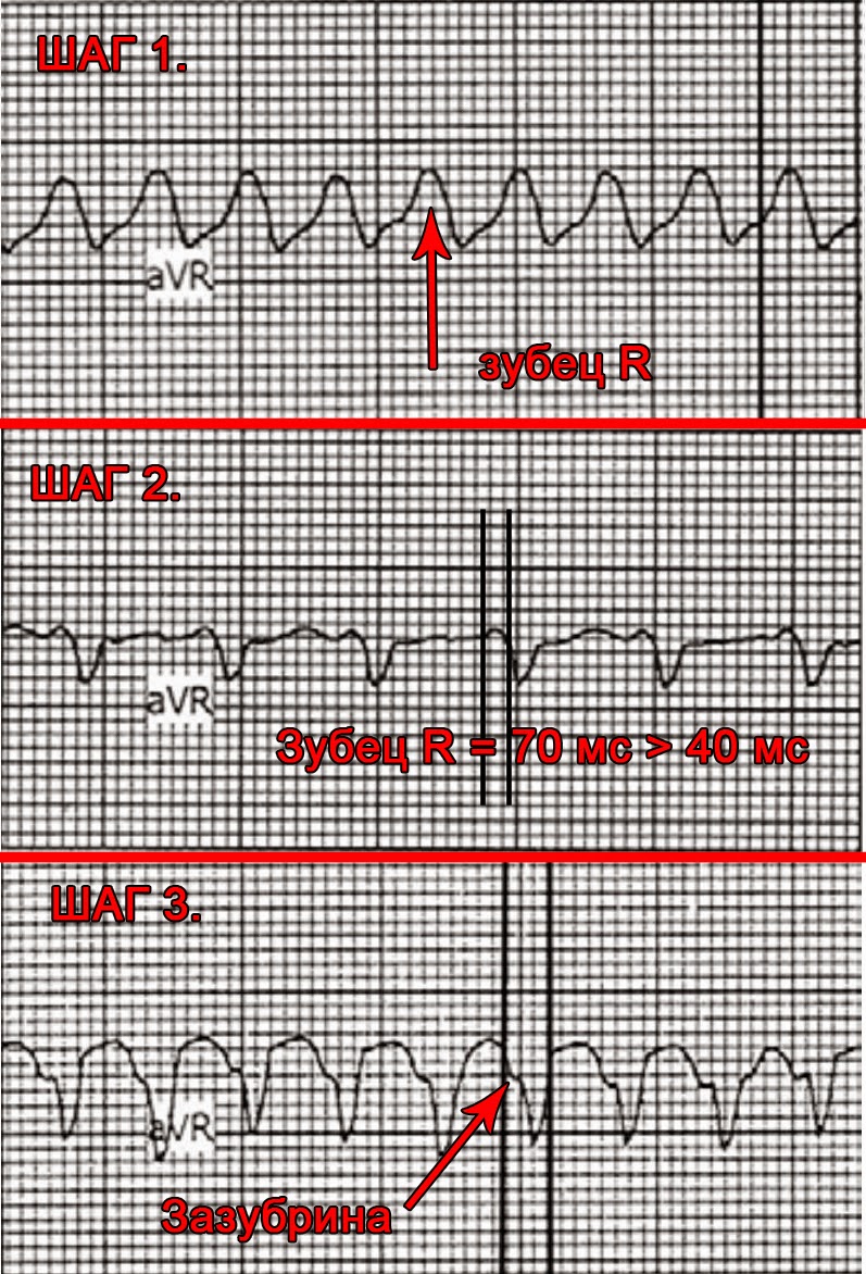 Eur heart j. Желудочковая тахикардия алгоритм Бругада. ЖТ ЭКГ критерии. Желудочковая тахикардия ЭКГ критерии. Критерии желудочковой тахикардии.